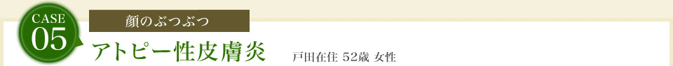 case05.[顔のぶつぶつ]アトピー性皮膚炎　戸田在住 52歳 女性